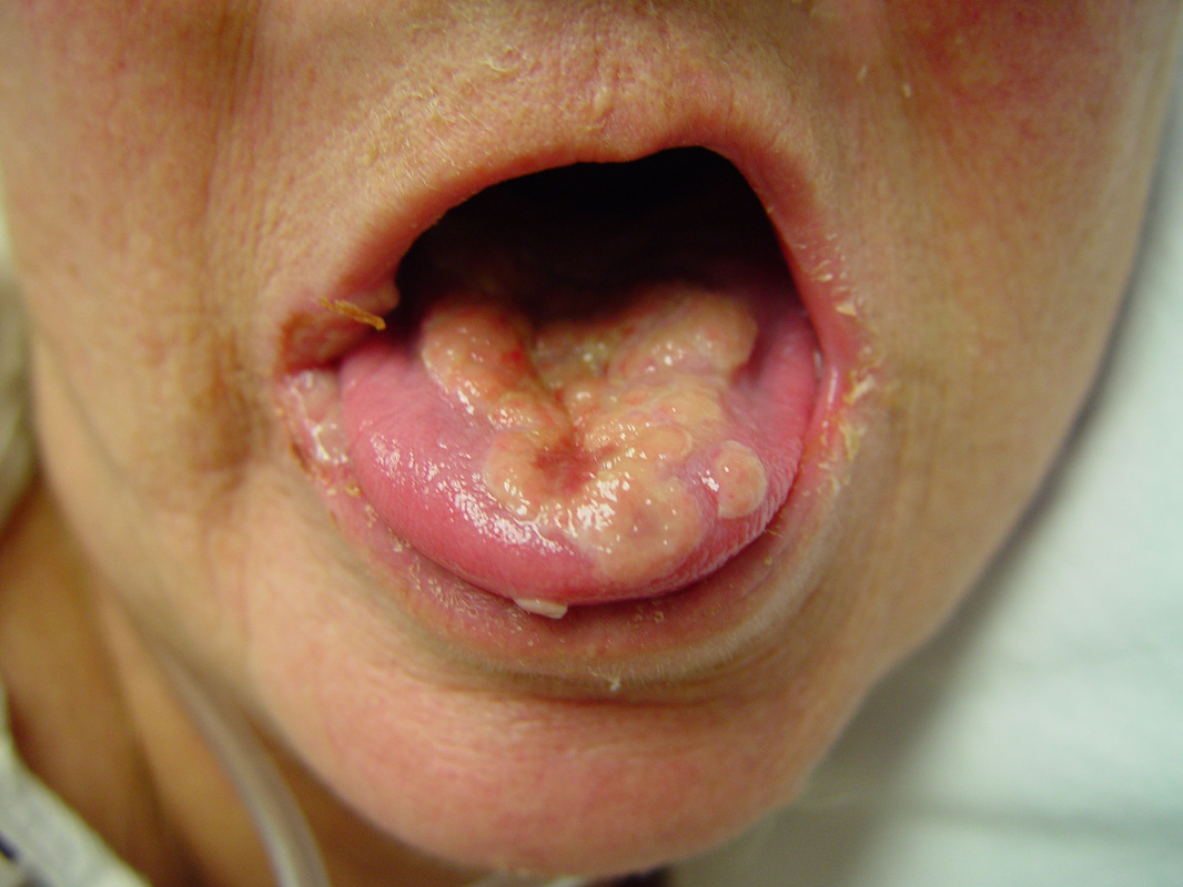 Herpes simplex virus: Type 1 and Type 2 Symptoms ...