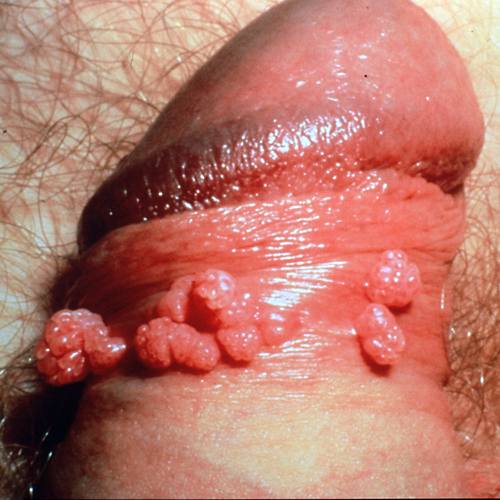 Symptoms of Throat Herpes | eHow